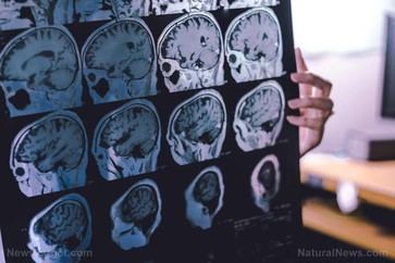 Estudio revela que la deficiencia de litio en el cerebro podría ser clave para entender y tratar el Alzheimer