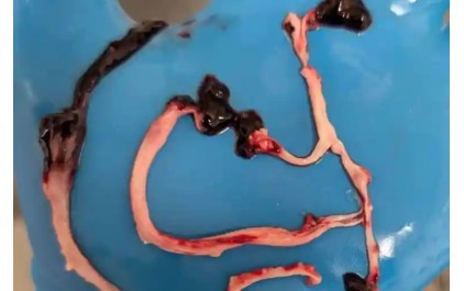 Descubren clots inusuales en cadáveres vinculados a vacunas COVID-19
