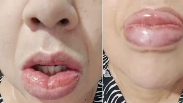 Colgate cesa la producción de pasta dental tras denuncias de reacciones adversas