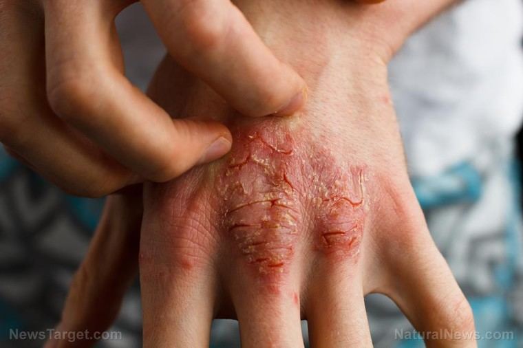 Eczema: Un desafío que afecta la piel y la salud mental