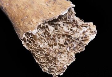 Medicamentos GLP-1 aumentan el riesgo de osteoporosis y pérdida ósea acelerada, según estudio