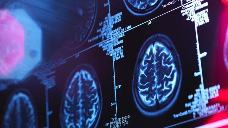 Investigadores desarrollan ultrasonido para tratar adicciones y depresión sin cirugía