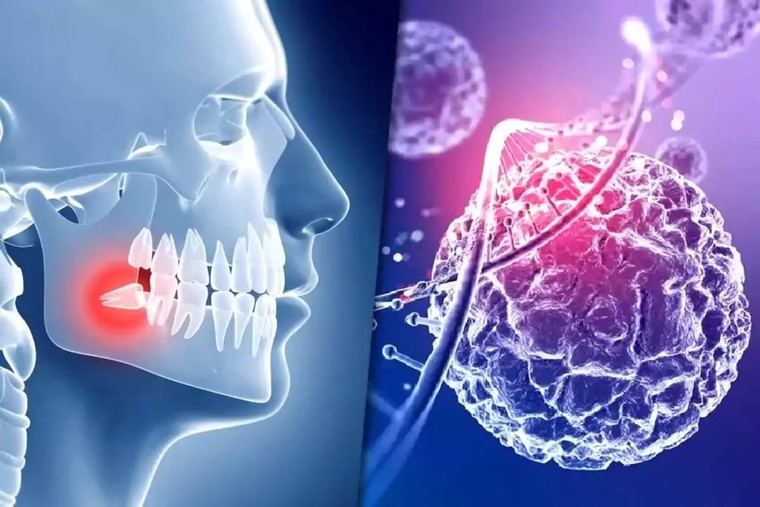 Muelas del juicio: un nuevo hallazgo para tratar enfermedades cerebrales