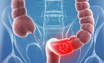 Actualización de guías sobre el cáncer colorrectal cuestiona efectividad de pruebas de detección