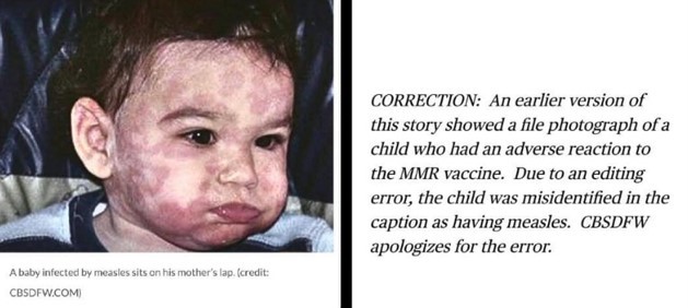 Muerte de niño en Texas malinterpretada como sarampión, pero fue por la vacuna MMR