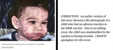 Muerte de niño en Texas malinterpretada como sarampión, pero fue por la vacuna MMR