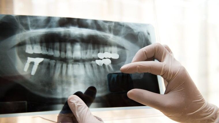 Estudio revela vínculo entre la pérdida de dientes y mayor riesgo de muerte en ancianos