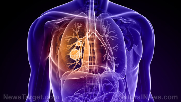 Dieta alta en alimentos ultraprocesados aumenta el riesgo de cáncer de pulmón, según estudio